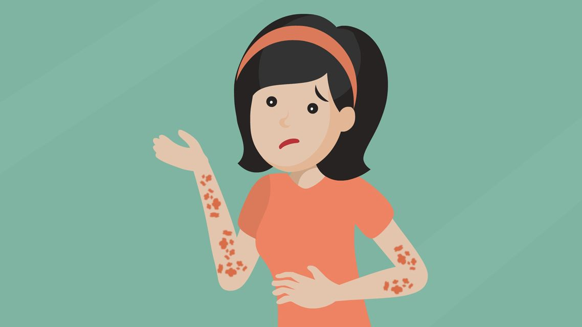 带状疱疹1:啥是带状疱疹?
